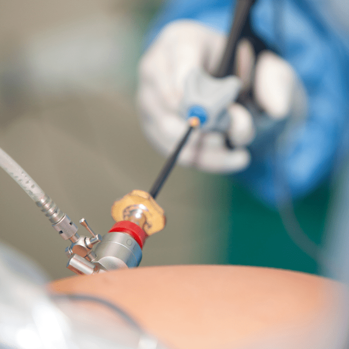 Cirugía laparoscopica CDMX