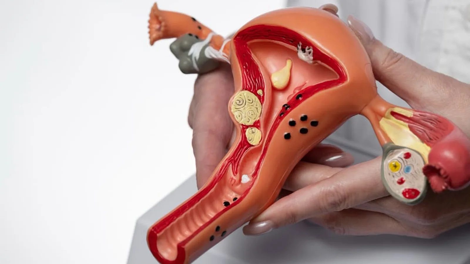 ¿Qué especialista trata la endometriosis?